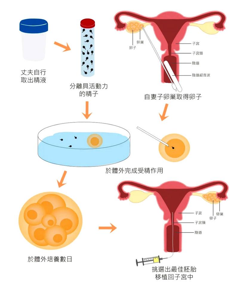 取卵手术时间与相关因素探讨